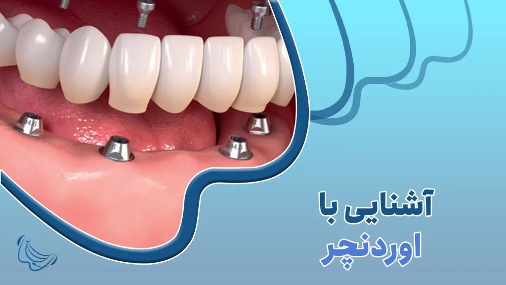 آشنایی با اوردنچر