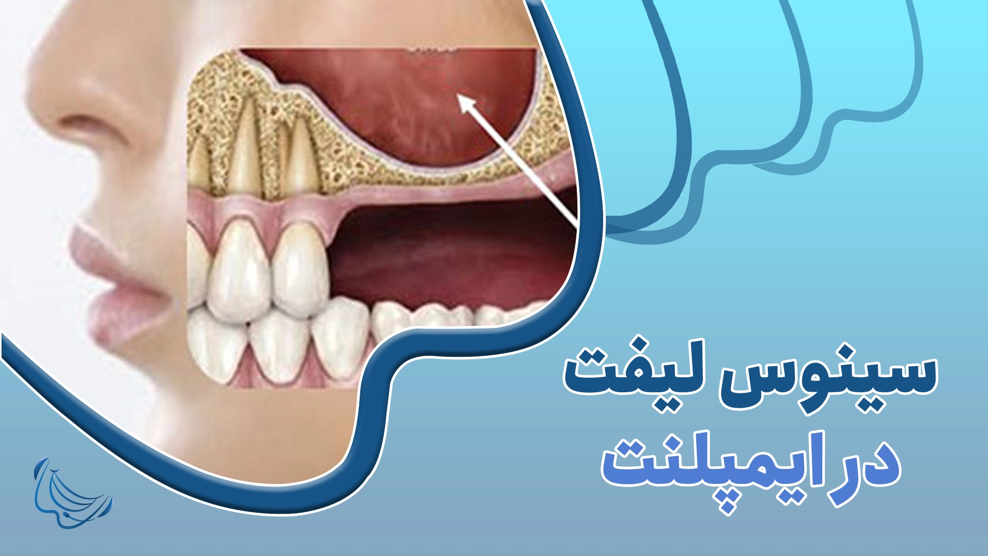 سینوس لیفت در کاشت ایمپلنت