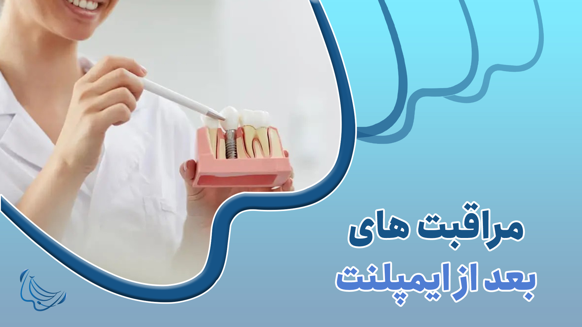 مراقبت های بعد از ایمپلنت