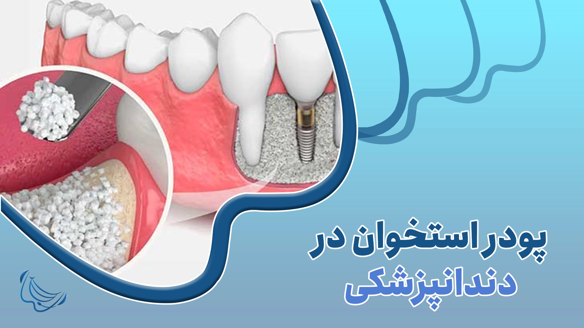 پودراستخوان در دندانپزشکی