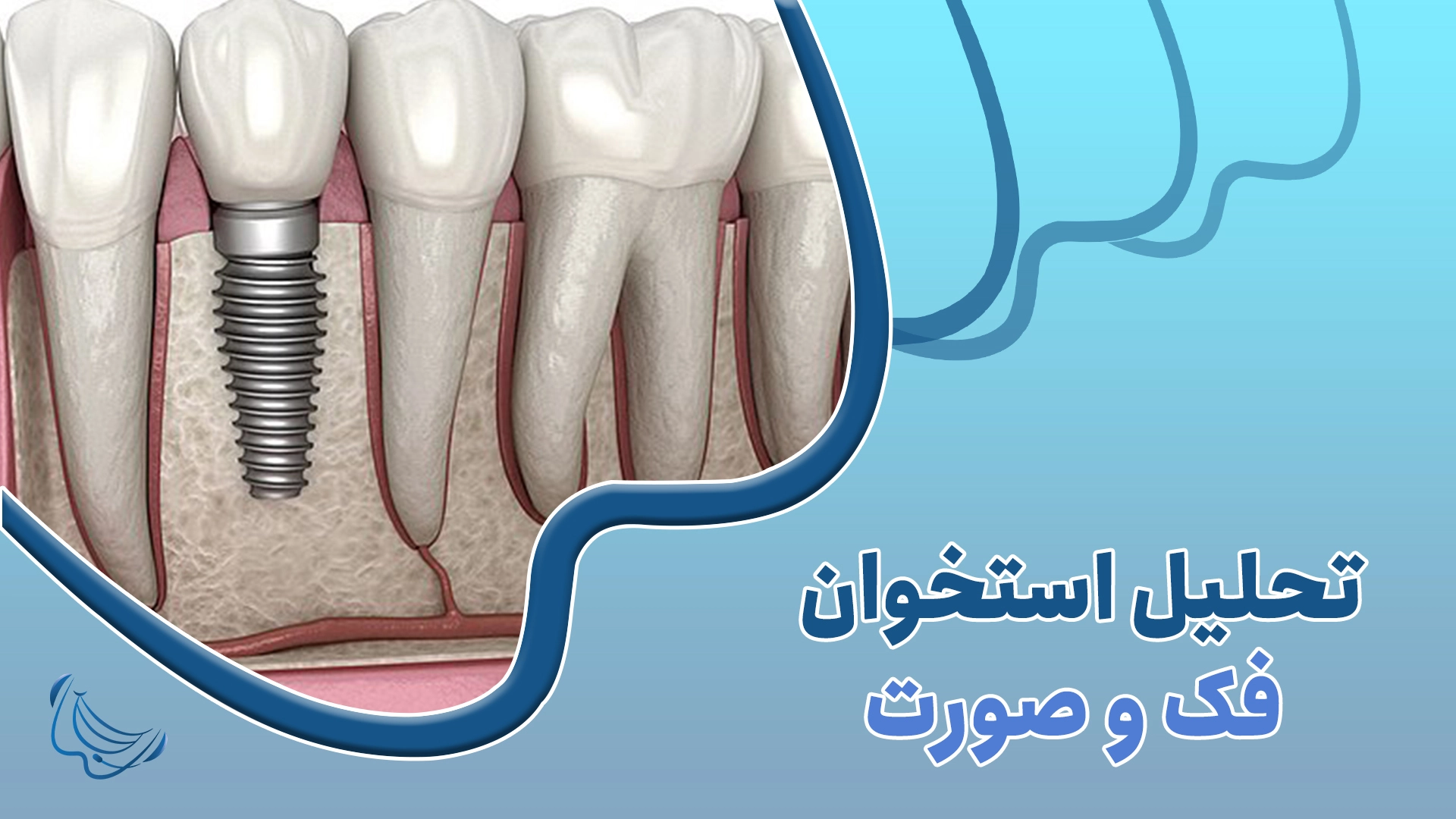 تحلیل استخوان فک