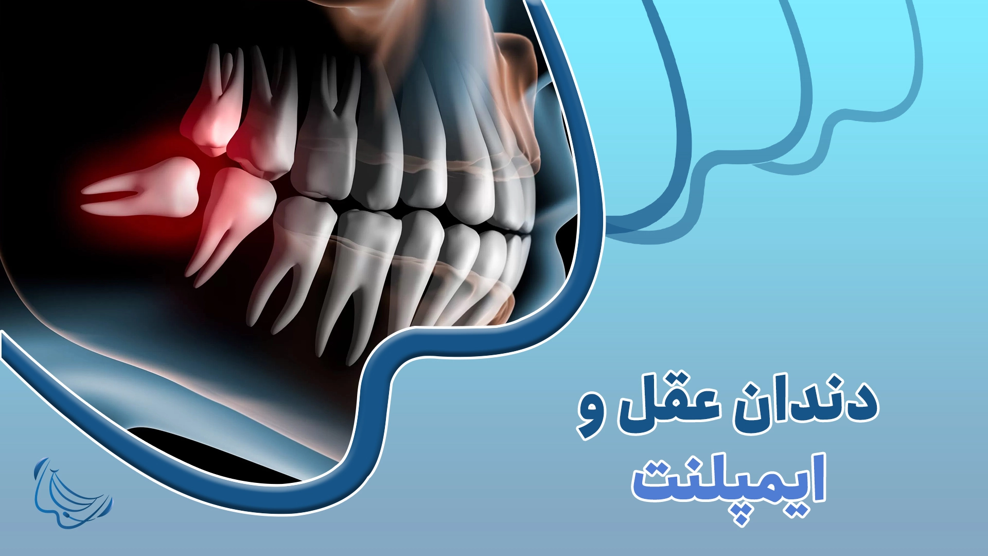 دندان عقل و ایمپلنت