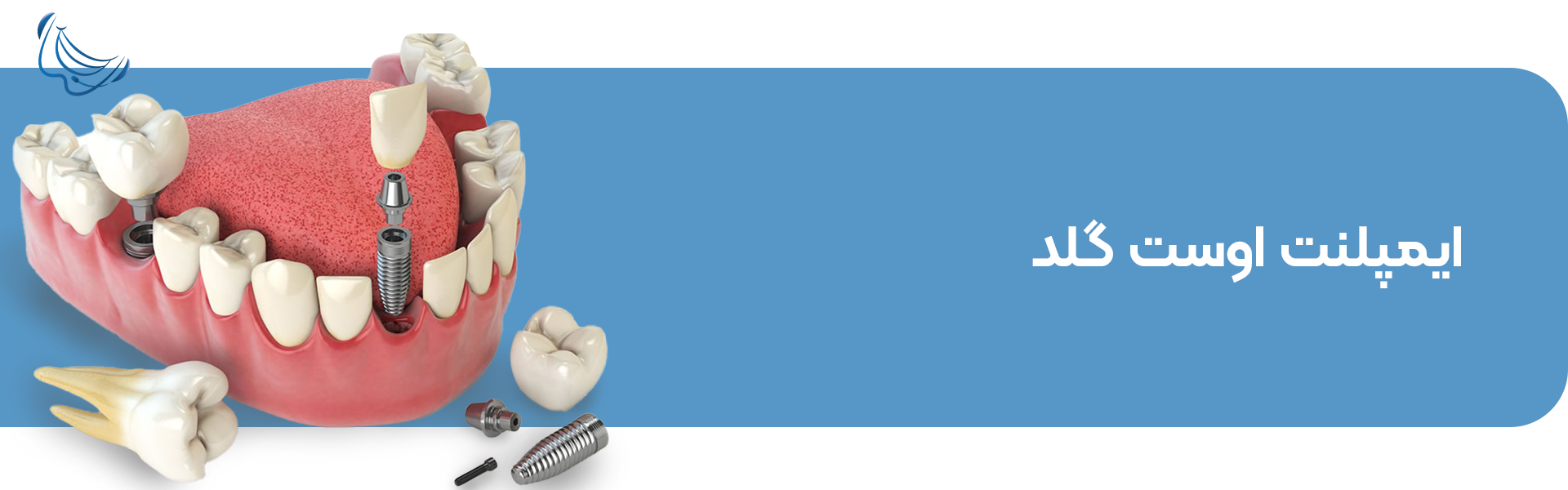 ایمپلنت دندان اوست گلد