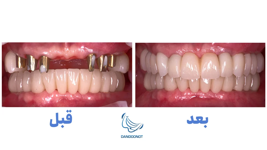 قیمت ایمپلنت دندان سال 1403