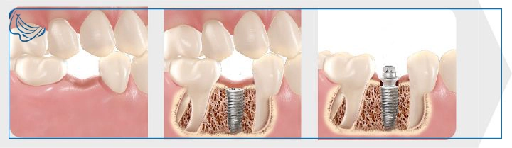 مراحل نصب ایمپلنت Neodent