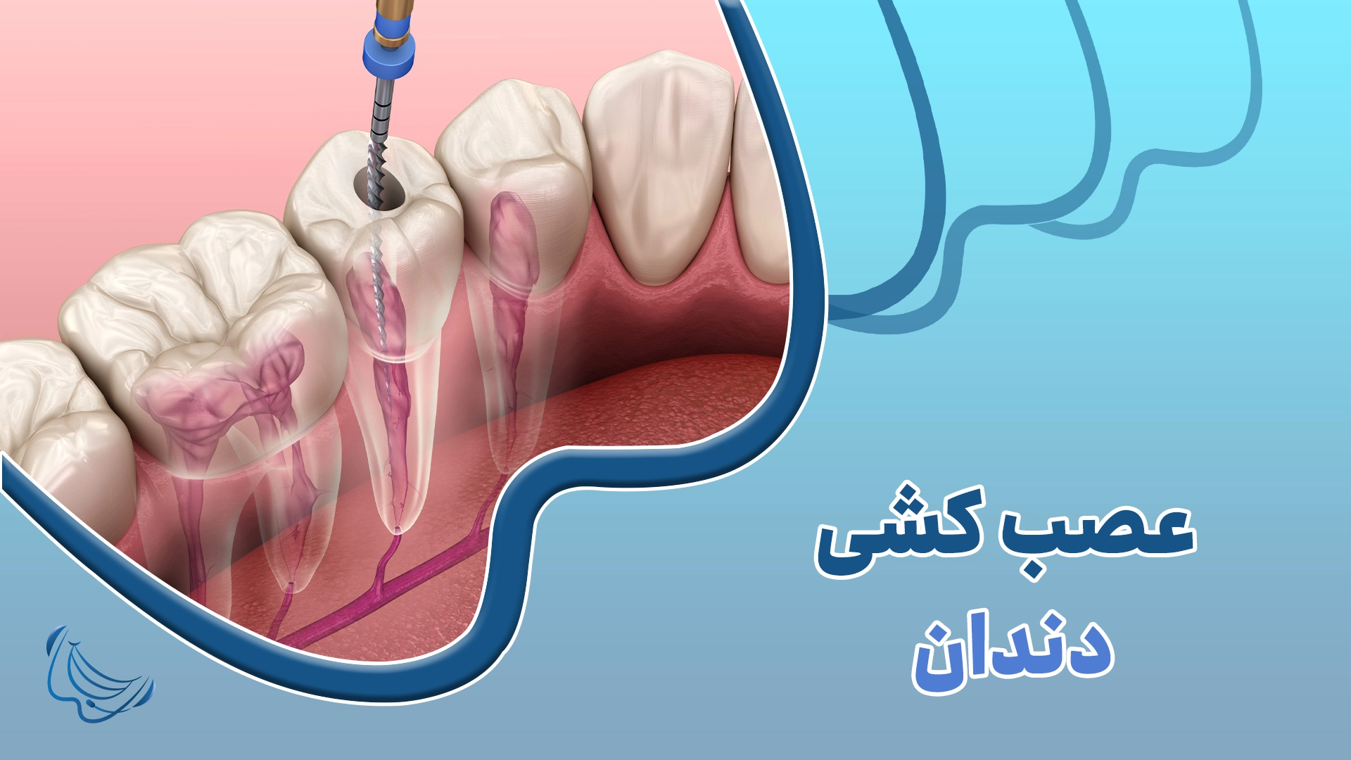 عصب کشی دو مرحله