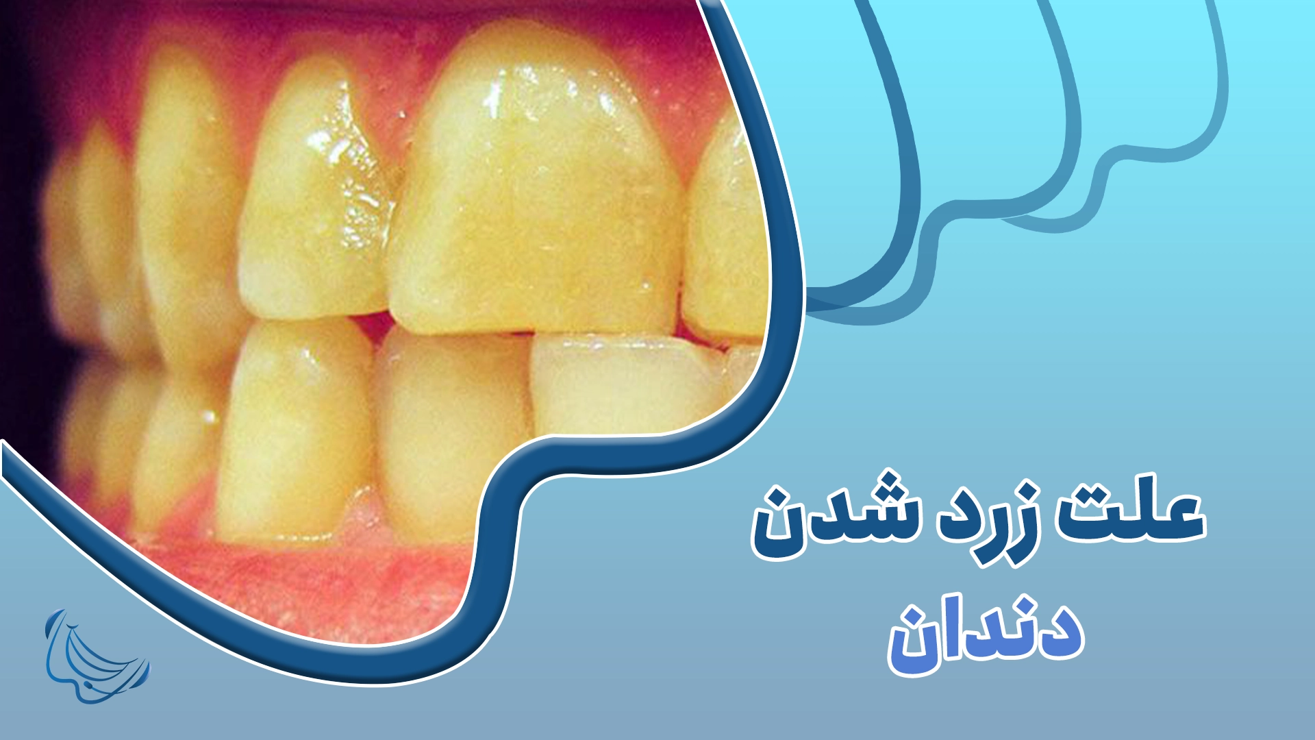 علت زرد شدن دندان