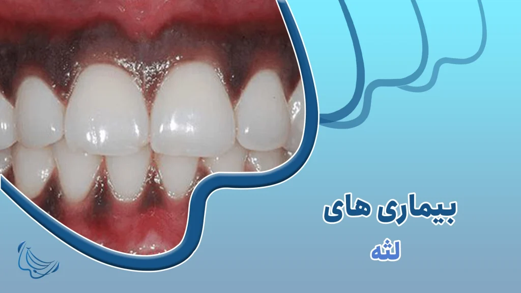 انواع بیماری های لثه 