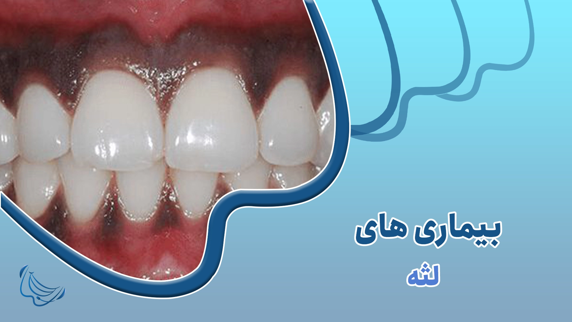 انواع بیماری های لثه 