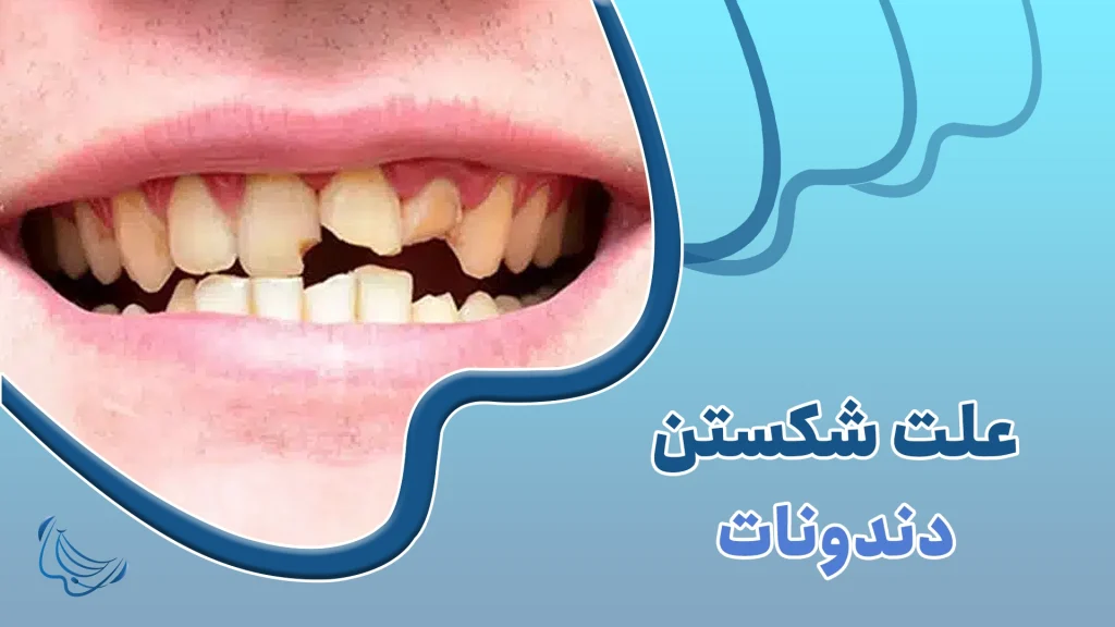 علت شکستن دندونات