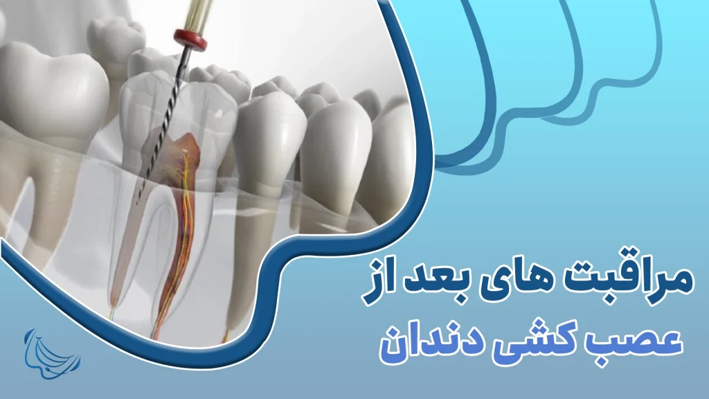 مراقبت های لازم بععد از عصبکشی،دندونات