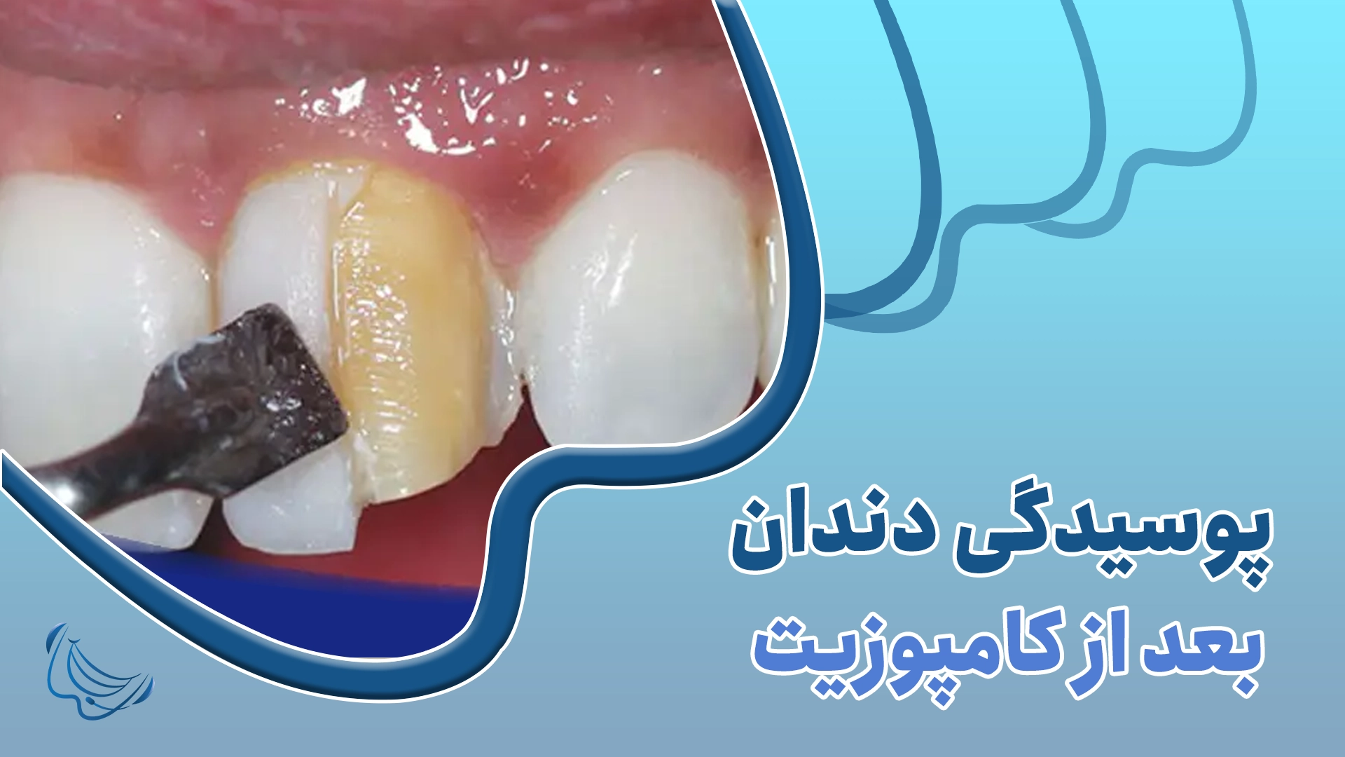 پوسیدگی بعد از کامپوزیت،دندونات