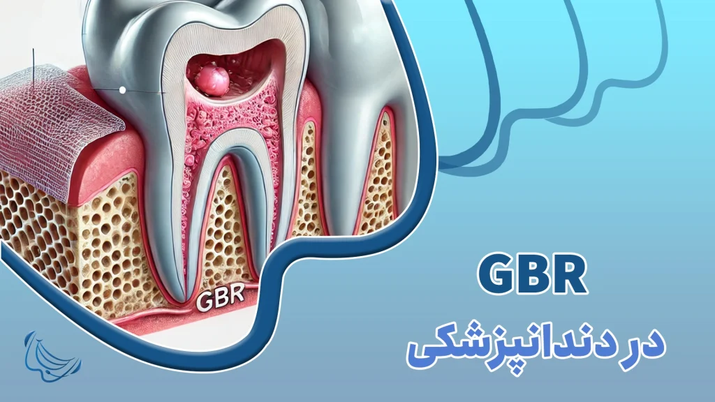 بازسازی هدایت‌شده استخوان (GBR)