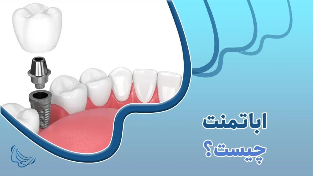 اباتمنت _دندونات