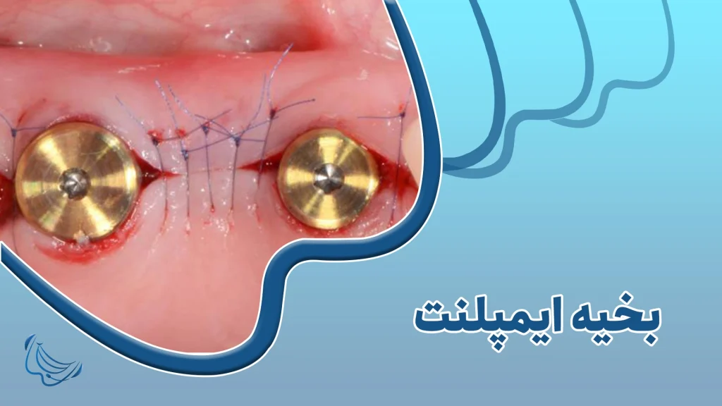 بخیه ایمپلنت