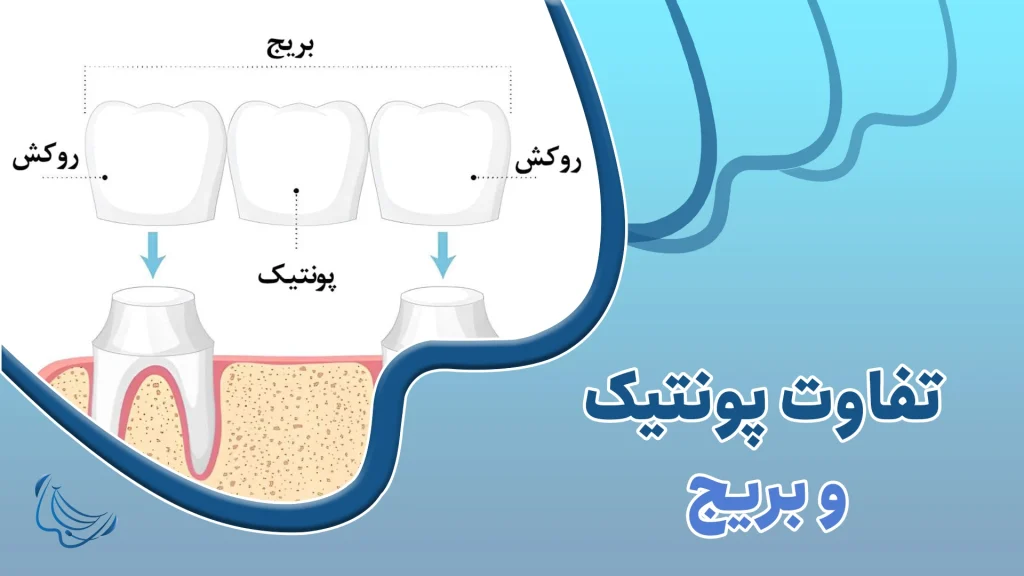 تفاوت پونتیک و بریج