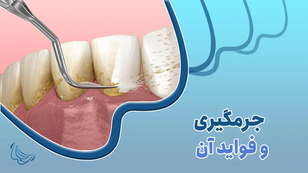 جرمگیری دندان