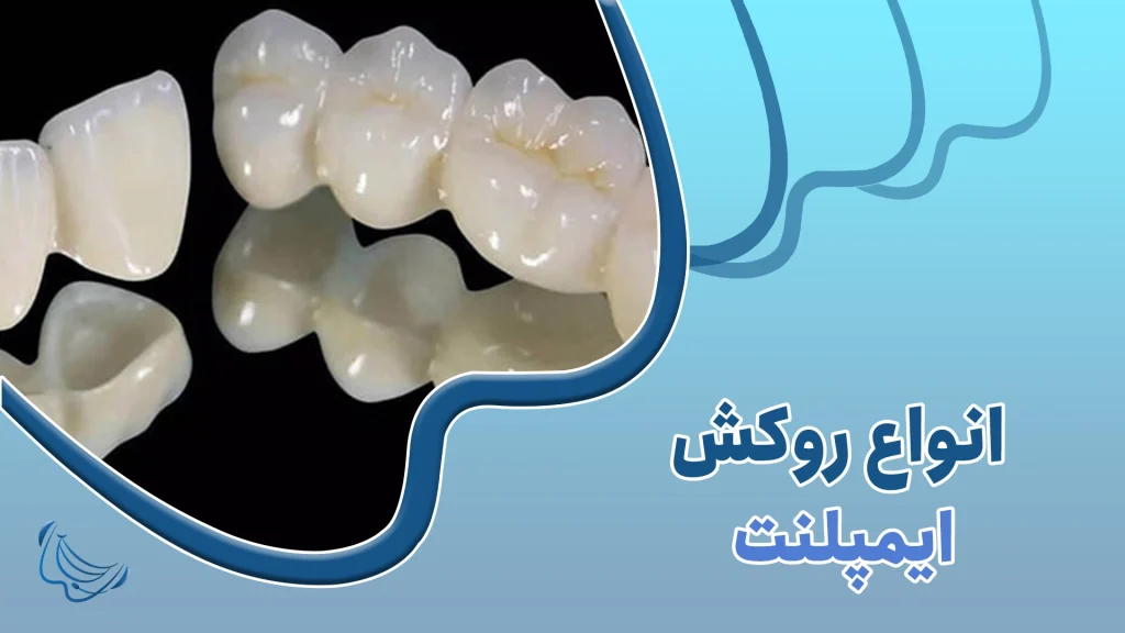 انواع روکش ایمپلنت