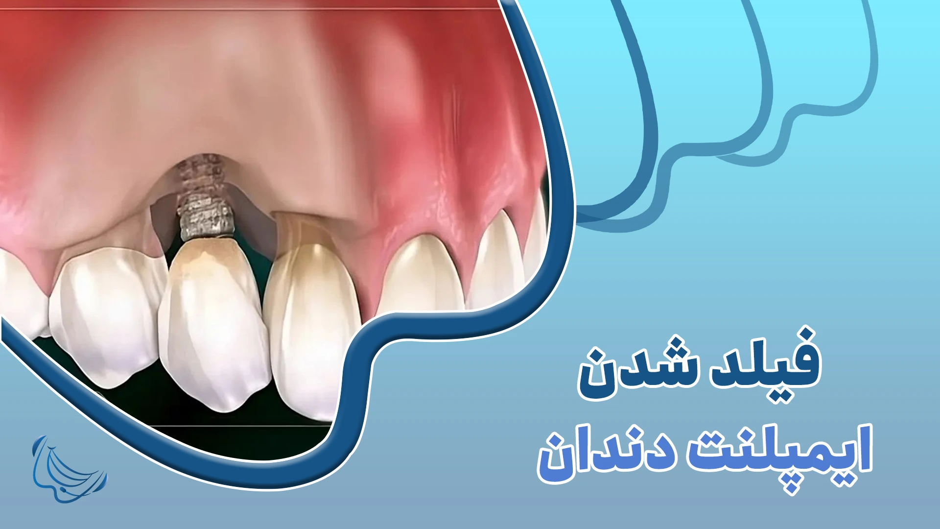 فیلد شدن ایمپلنت