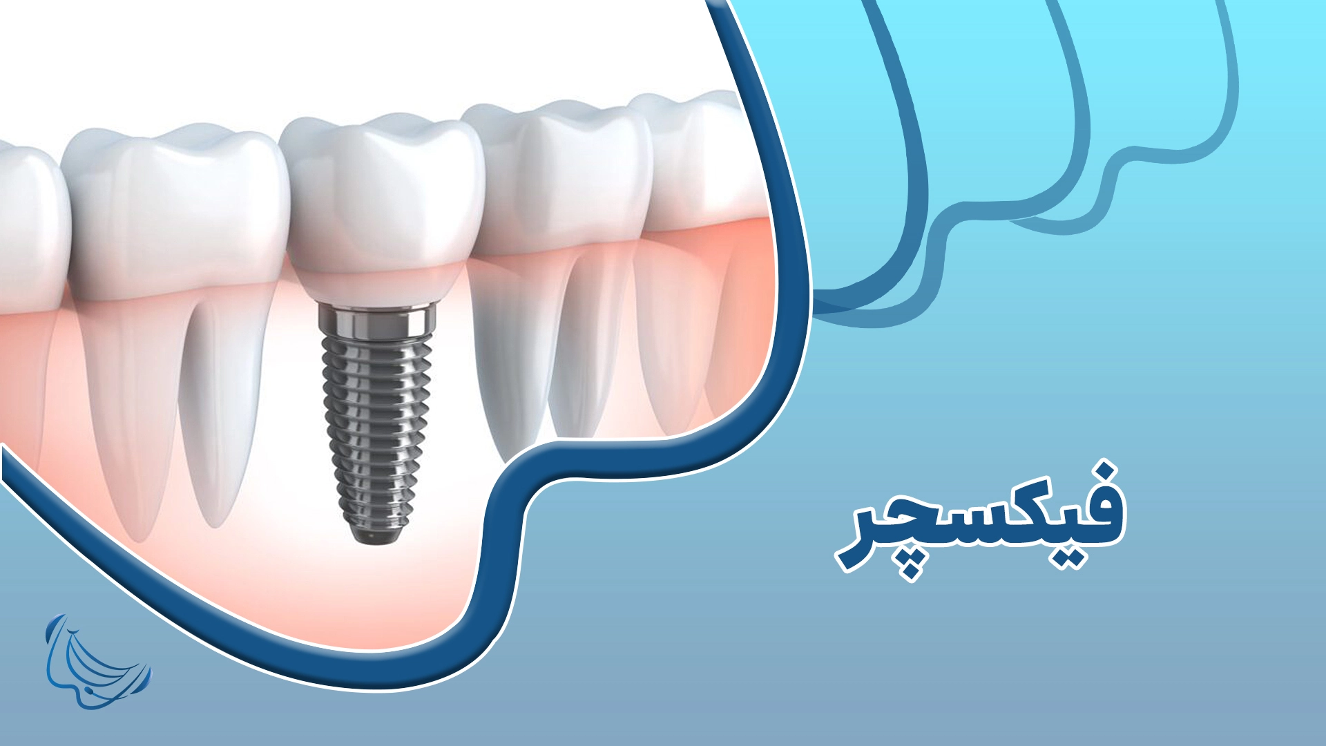 فیکسچر (Fixture) چیست