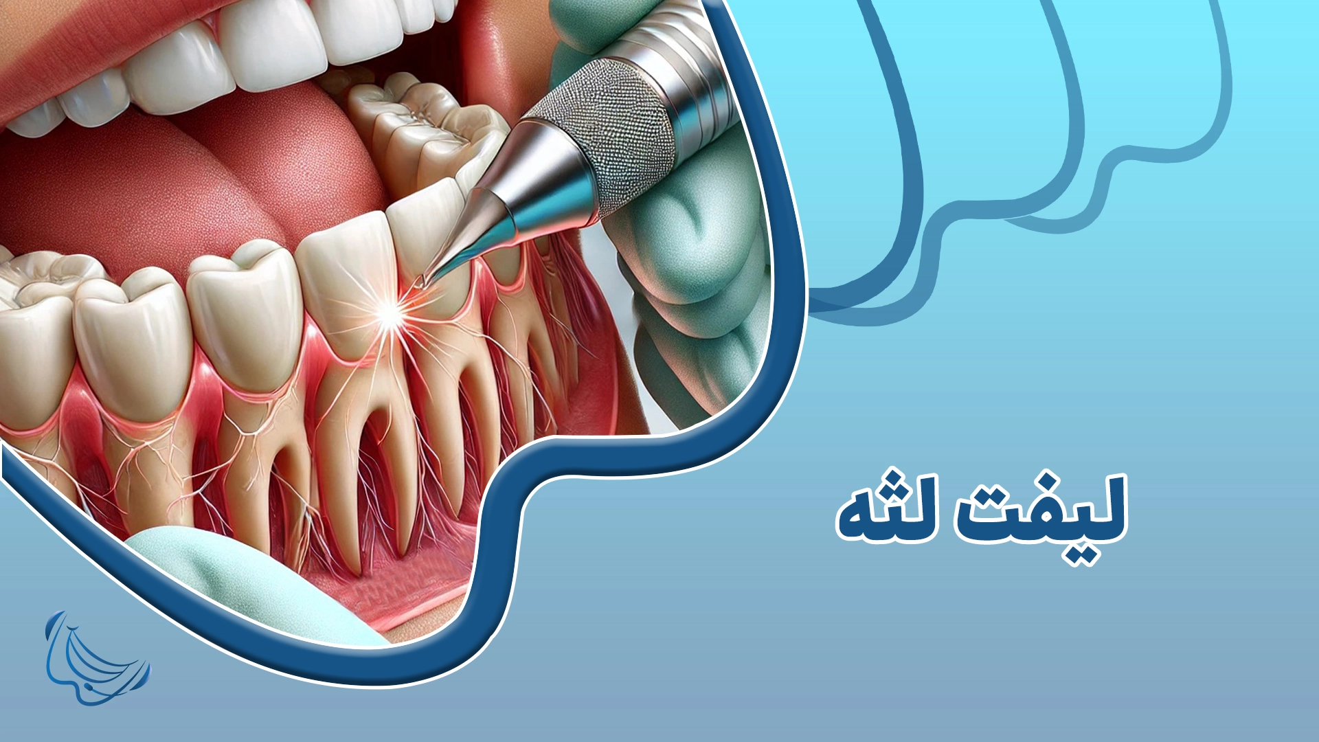 لیفت لثه یا کانتورینگ لثه: تفاوتها، روشها و مزایا