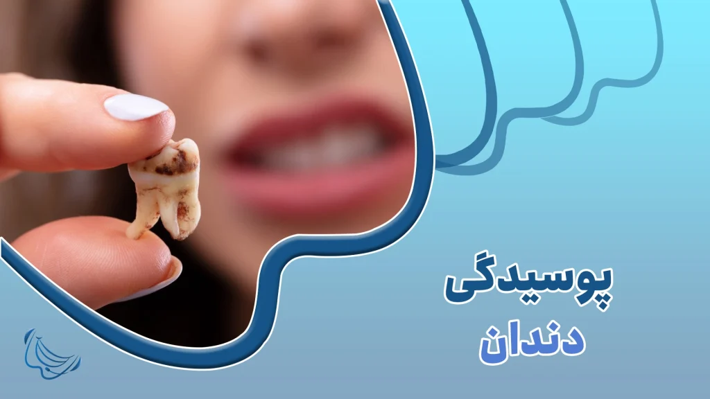پوسیدگی دندان