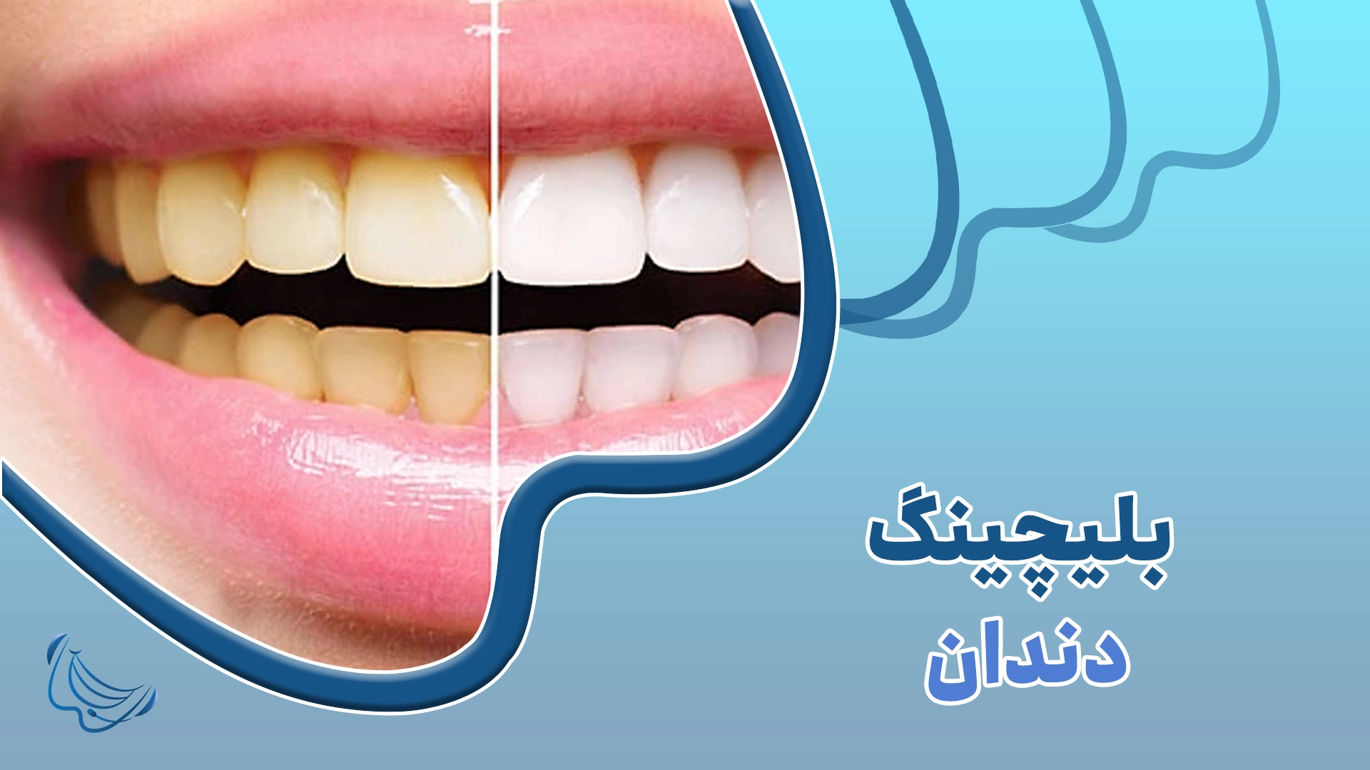 بلیچینگ دندان