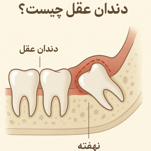 دندان عقل نهفته