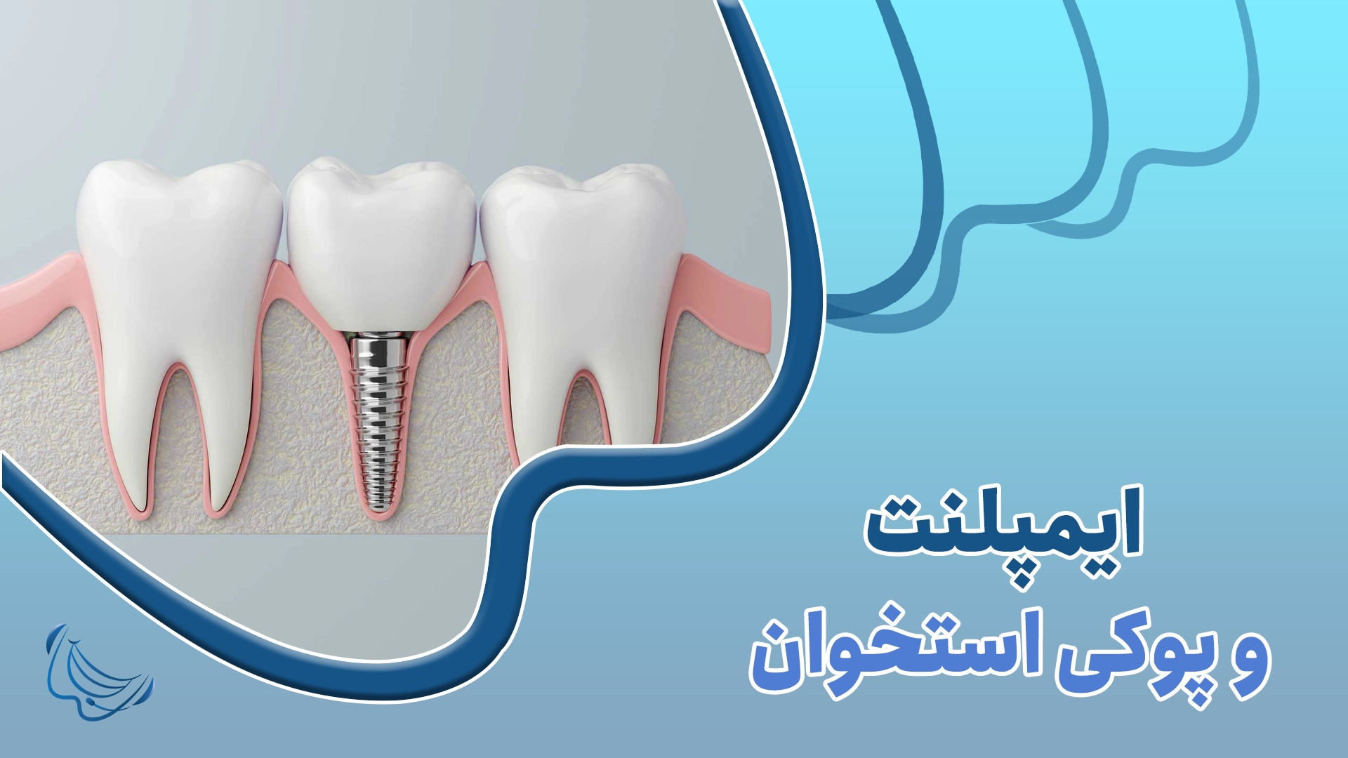 ایمپلنت دندان در بیماران دارای پوکی استخوان