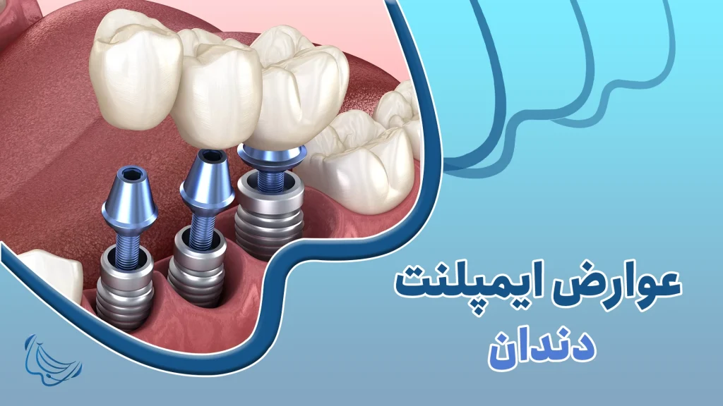عوارض ایمپلنت دندان