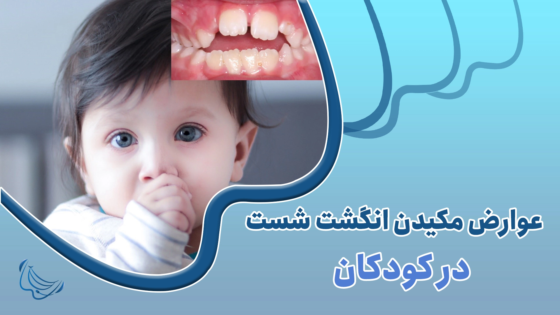 عوارض مکیدن انگشت شست در کودکان