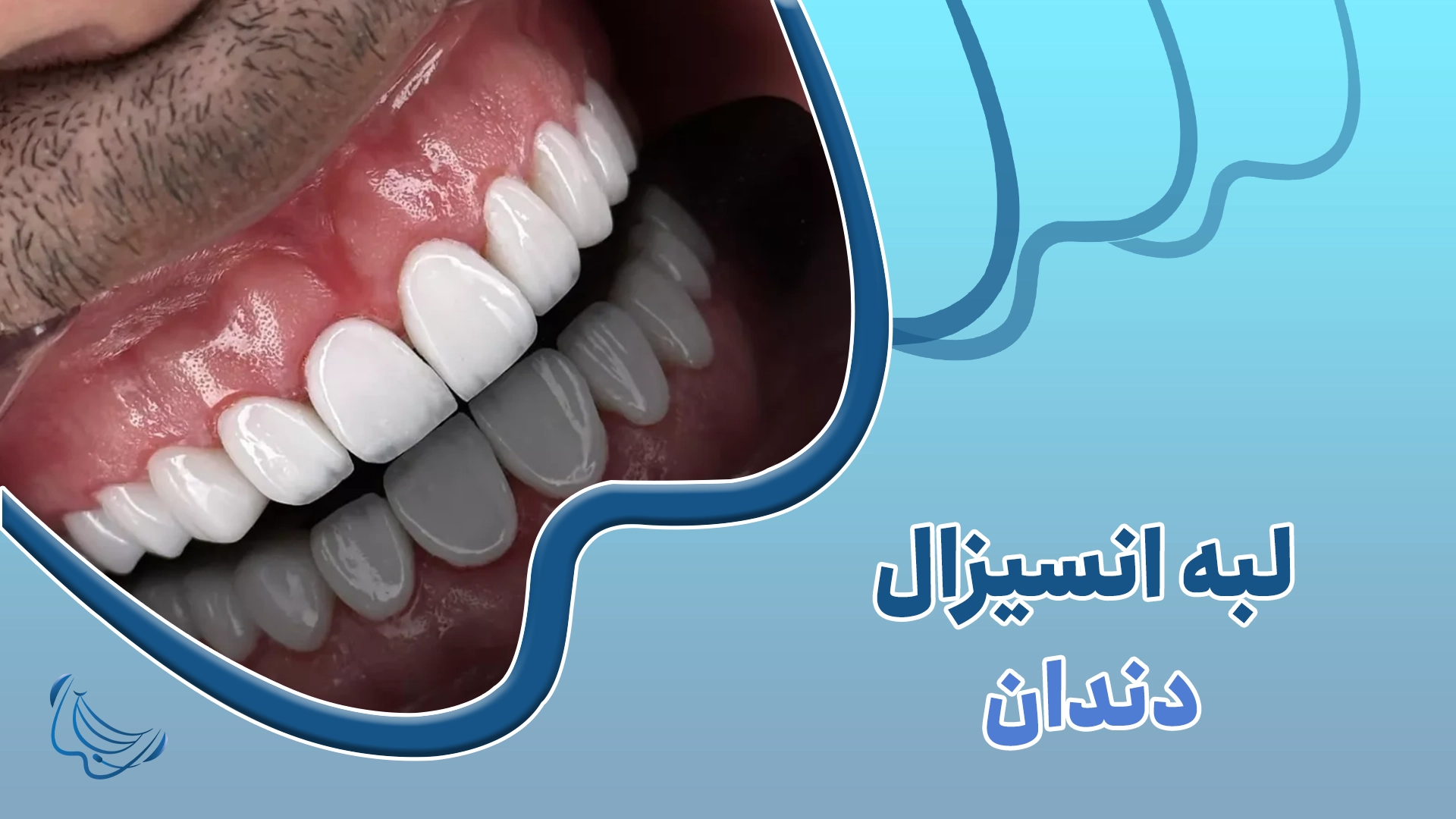 لبه انسیزال دندان