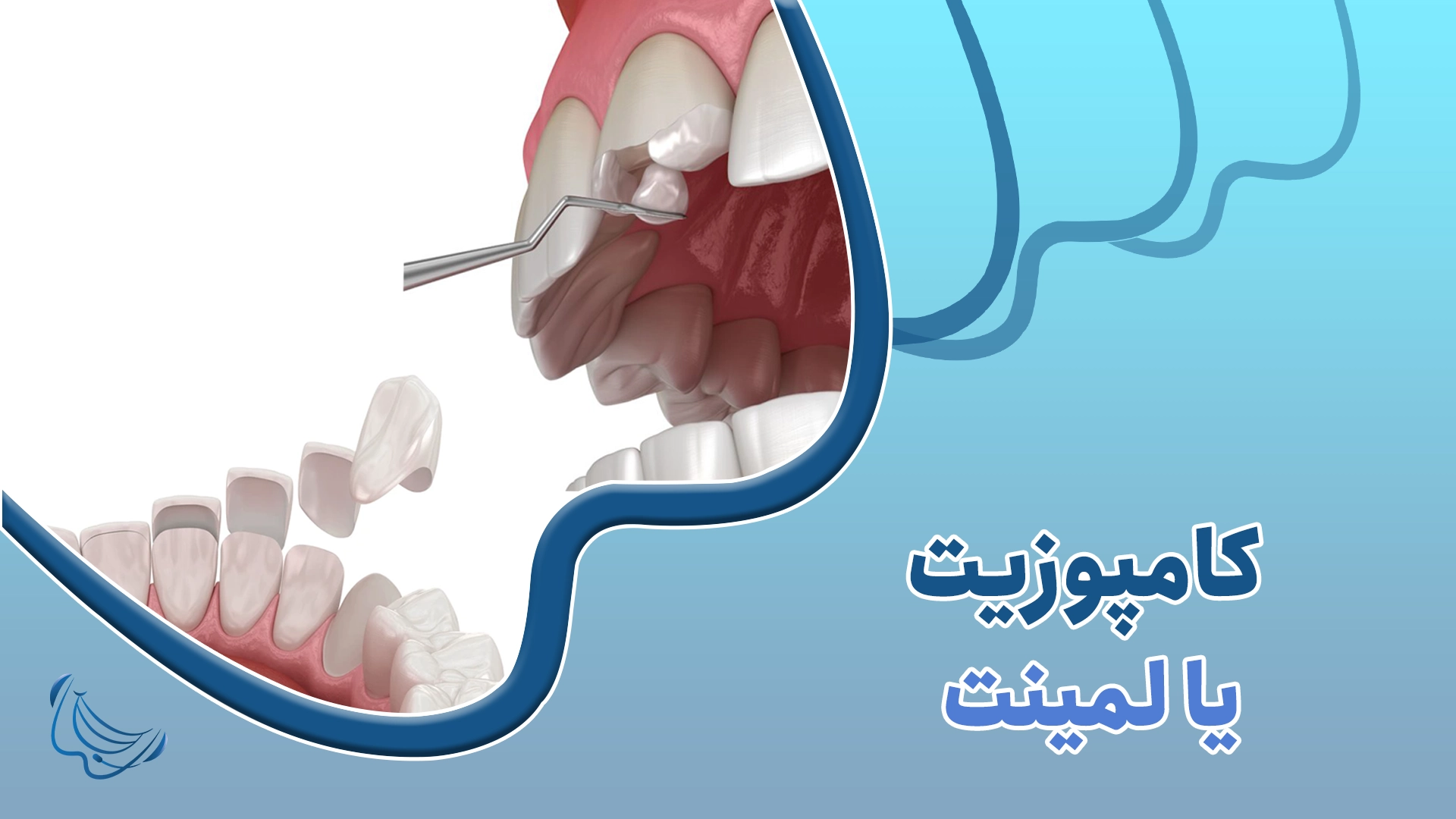 مقایسه کامپوزیت و لمینت دندان