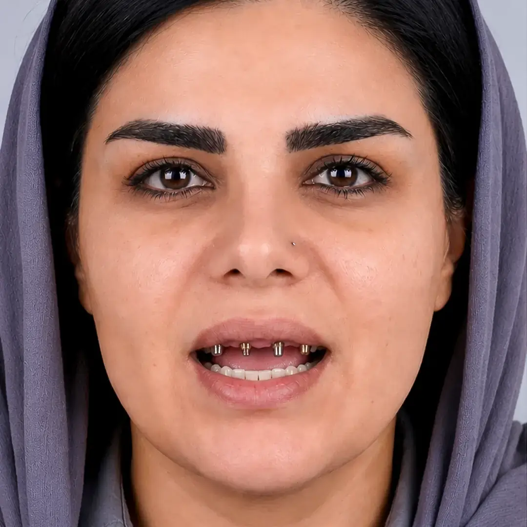 عکس قبل ایمپلنت دندان
