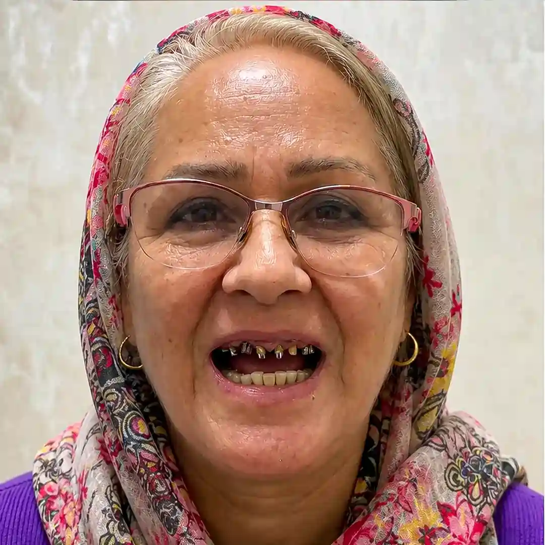 عکس قبل ایمپلنت دندان طبیعی