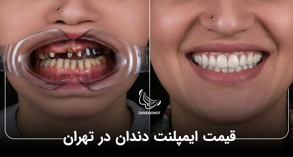 قیمت ایمپلنت دندان در تهران