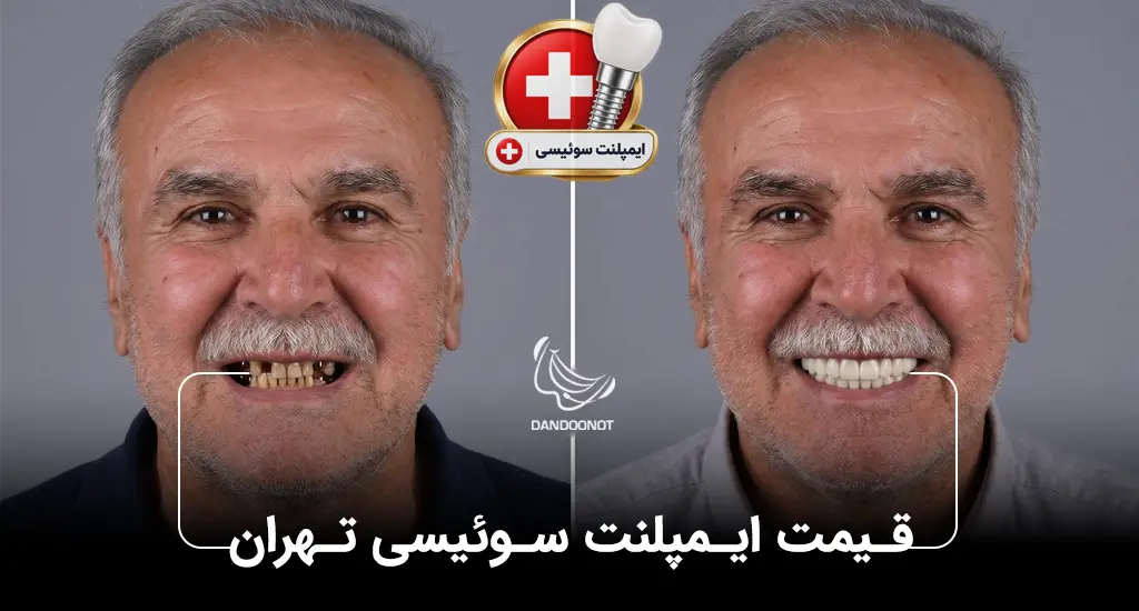 قیمت ایمپلنت سوئیسی 1405